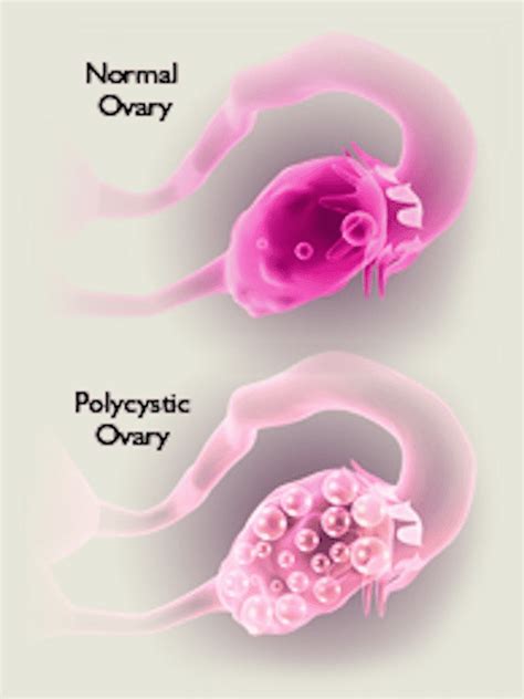 Polycystic Ovary Syndrome Pcos Overview Of Symptoms And Causes