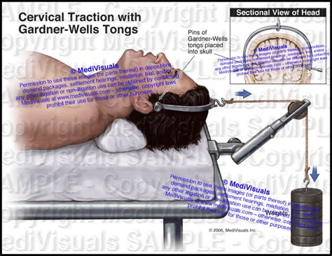 Cervical Traction With Gardner Wells Tongs Medivisuals Inc