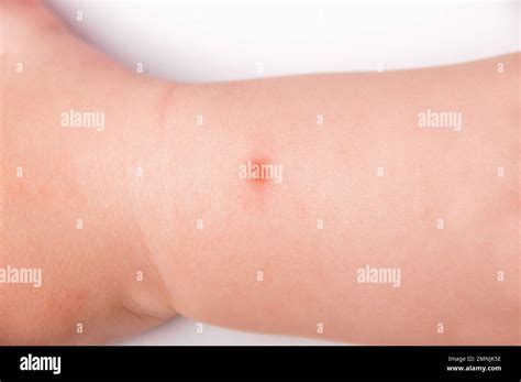 Picaduras de mosquito dolor y cicatriz en el brazo del niño Fotografía de stock Alamy