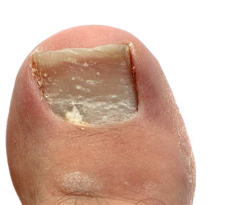 White Spots On Toenails After Pedicure Nail Ftempo