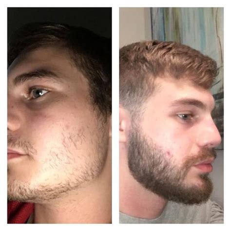 Minoxidil Before And After Beard Result If You Ve Tried To Grow One