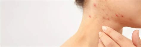 5 Simple Ways To Get Rid Of Pimples On Neck Euromed Clinic
