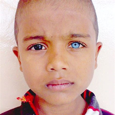 Heterochromia Iridum Is When The Person Has Eyes Of Different Heterochromia Heterochromia