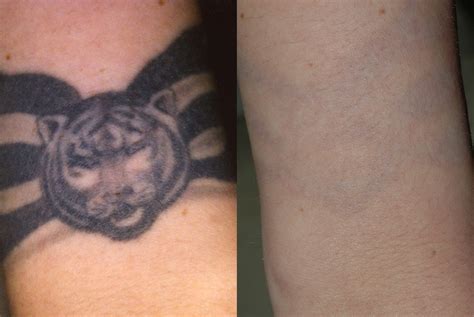Laser Removal Of Tattoos
