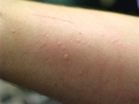 Home Remedies For Hives For Fast Relief