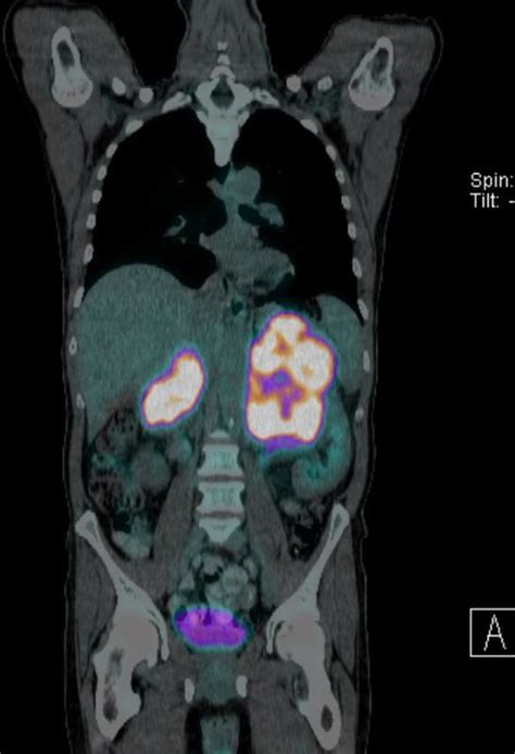 Primary Adrenal Lymphoma With Initial Presentation Concerning For