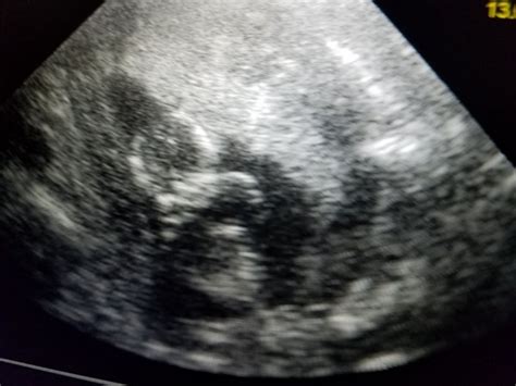 Anterior Placenta Babycenter