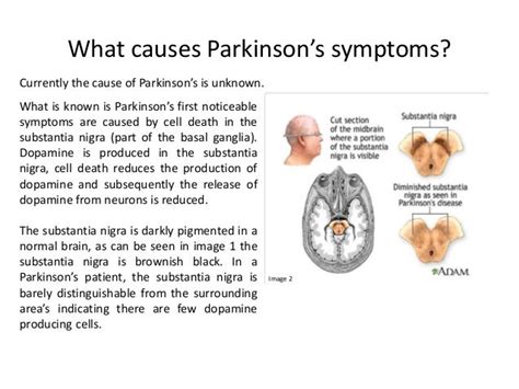 Understanding The Brain Final Project Parkinsons Disease