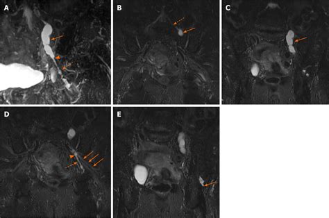 Intraneural Ganglion Cyst Of The Lumbosacral Plexus Mimicking L5