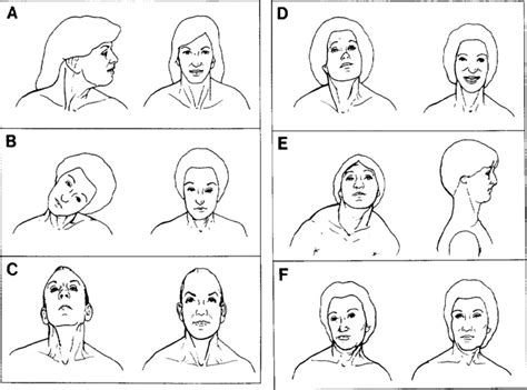 Treatment Of Spasmodic Torticollis With Intradural Selective