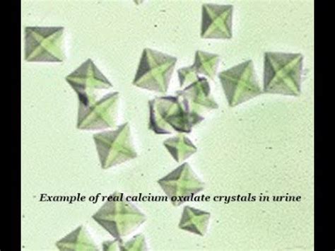 All forms are colorless or white. very nice Calcium oxalate crystal in urine - YouTube