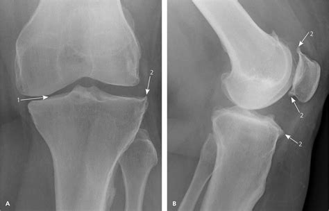 Degenerative Joint Disease Causes And Treatment