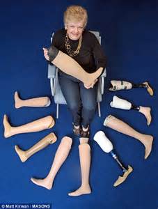 Slimmer Who Lost A Leg To Diabetes Went Through Eleven Prosthetic Limbs