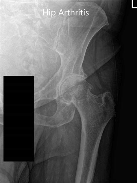 Case Study Robotic Left Hip Replacement In 71 Yr Old Female