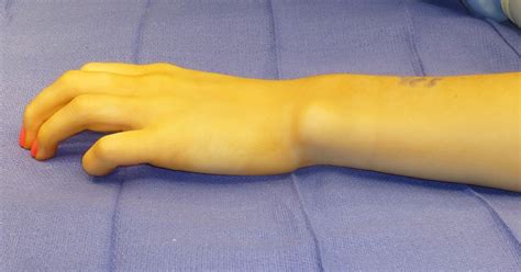 Traumatic Madelungs Deformity Congenital Hand And Arm Differences