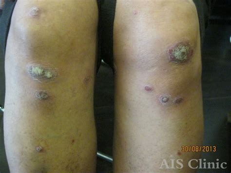 Psoriasis More Than Skin Deep Ais Clinic