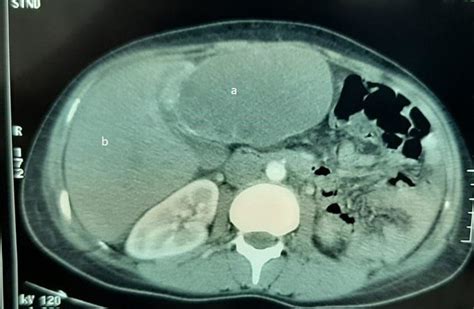 Abdominal Ct Scan Showing A Hydatid Cyst Of The Left Lobe Of The Liver
