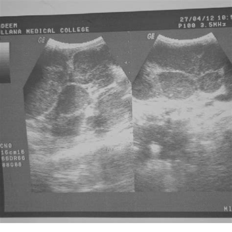 Ultrasonography Of The Neck Showing Enlarged Discrete Hypoechoic Lymph