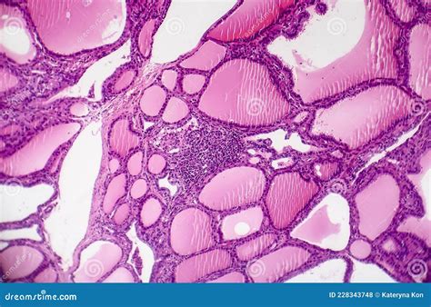 Toxic Diffuse Goiter Or Graves Disease Light Micrograph Stock Photo