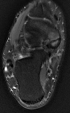 Accessory Navicular Syndrome Radiology Reference Article
