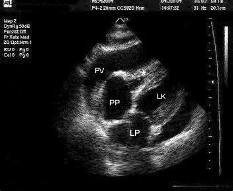 Transthoracic Echocardiography In Subcostal View Showing Right