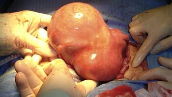 Nyeri panggul akibat fibroid rahim terdiri dari dua jenis, yaitu nyeri panggul siklik dan. Lyickherry: ELAK KETUMBUHAN FIBROID DALAM RAHIM DENGAN 6 ...