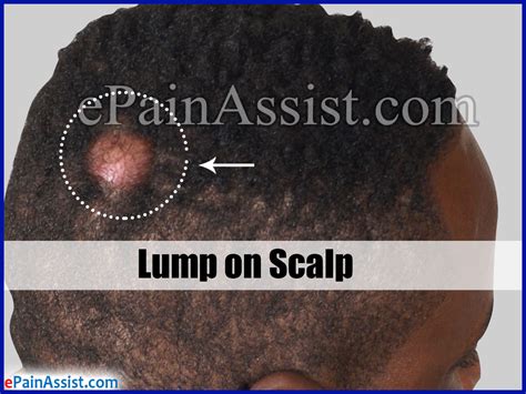 What Causes Lumps On Scalp And Natural Remedies To Get Rid Of It