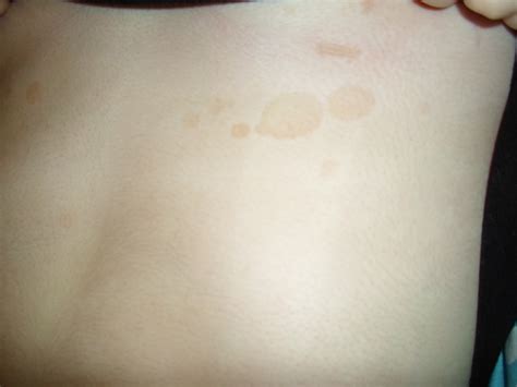 Why Do I Have Red Spots On My Chest Design Talk