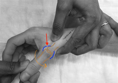 Skiers Thumb An Injury To The Ulna Collateral Ligament Of The Thumb
