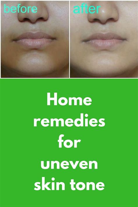 Home Remedies For Uneven Skin Tone Uneven Skin Tone Uneven Skin