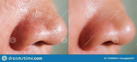 Before And After Acne On Nose Treatment Stock Photo Image Of Concept