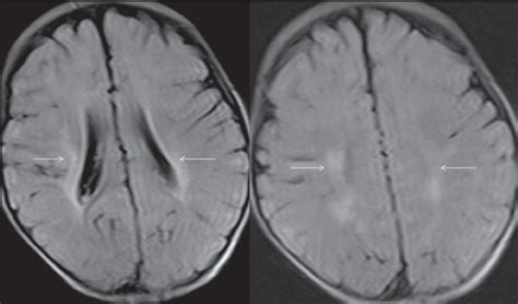 Anoxic Brain Injury Ct Scan Findings Ct Scan Machine