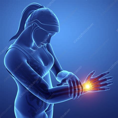 Woman With Wrist Pain Illustration Stock Image F022