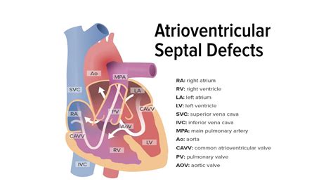 Atrioventricular Septal Defect Avsd Concise Medical Knowledge