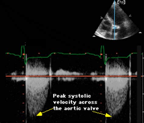 Aortic Stenosis Echocardiography Wikidoc