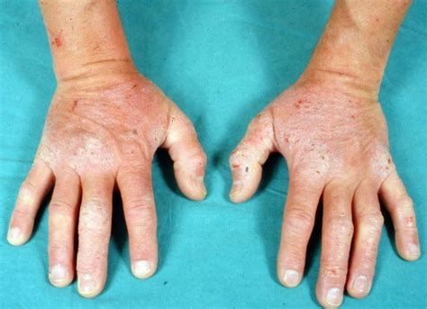 Dermatite Herpétiforme Photos