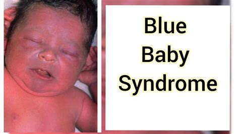 Blue Baby Syndrome 🔵 Neet Previous Year Biology Question Youtube