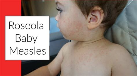 Roseola Baby Measles Dr Joann Child Specialist