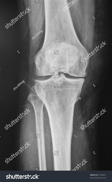 Collection Xray Normal Knee Stock Photo 81036631 Shutterstock