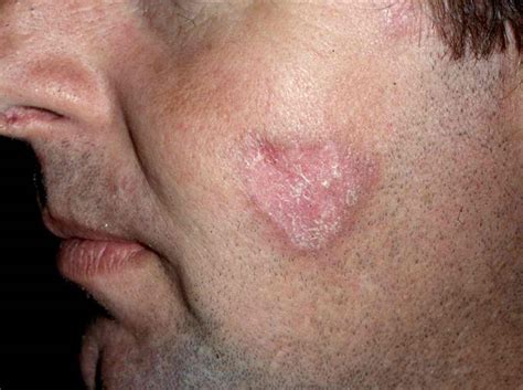 Cutaneous Lupus Or Skin Lupus Systemic Lupus