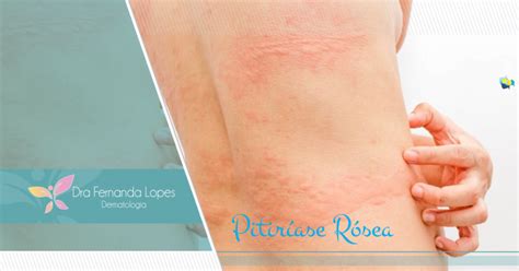 Dra Fernanda Lopes Dermatologia Blog Pitiríase Rósea