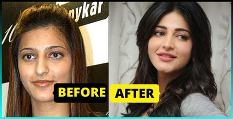 18 Bollywood Celebrities Who Did Lip Surgery To Look Beautiful