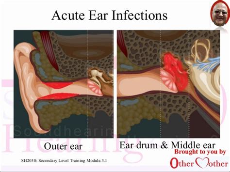 Common Ear Diseases