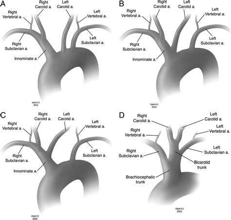 Figure 1 Bovine Arch And Other Aortic Arch Variations