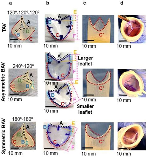 Bicuspid Aortic Valve Morphology And Aortic Valvular Outflow Jets An