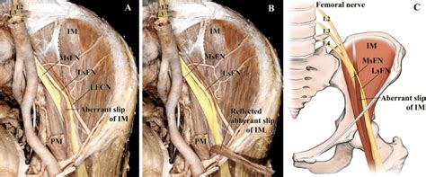 Iliac Fossa