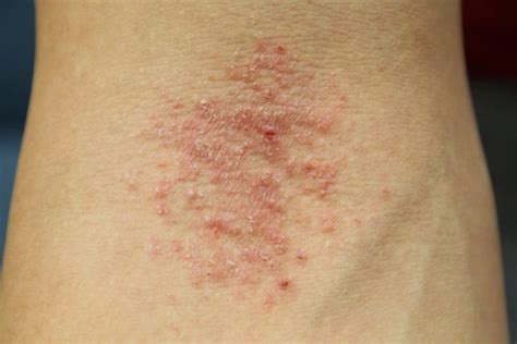 Bệnh Eczema Là Bệnh Gì Nguyên Nhân Và Cách Trị Bệnh Hiệu Quả