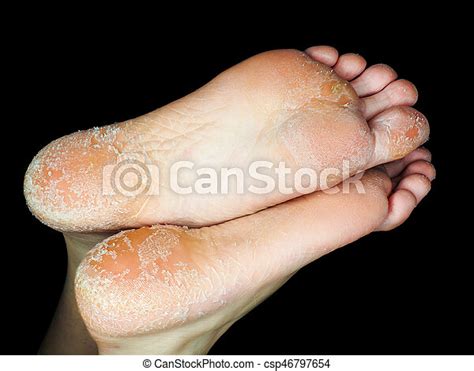 Skin Peeling Off From Both Feet On Adult Person Isolated Towards Black