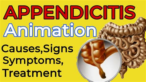 Appendicitis Appendicitis Causes Signs Symptoms Diagnosis Treatment