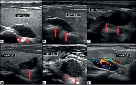 Parathyroid Tumor Ultrasound